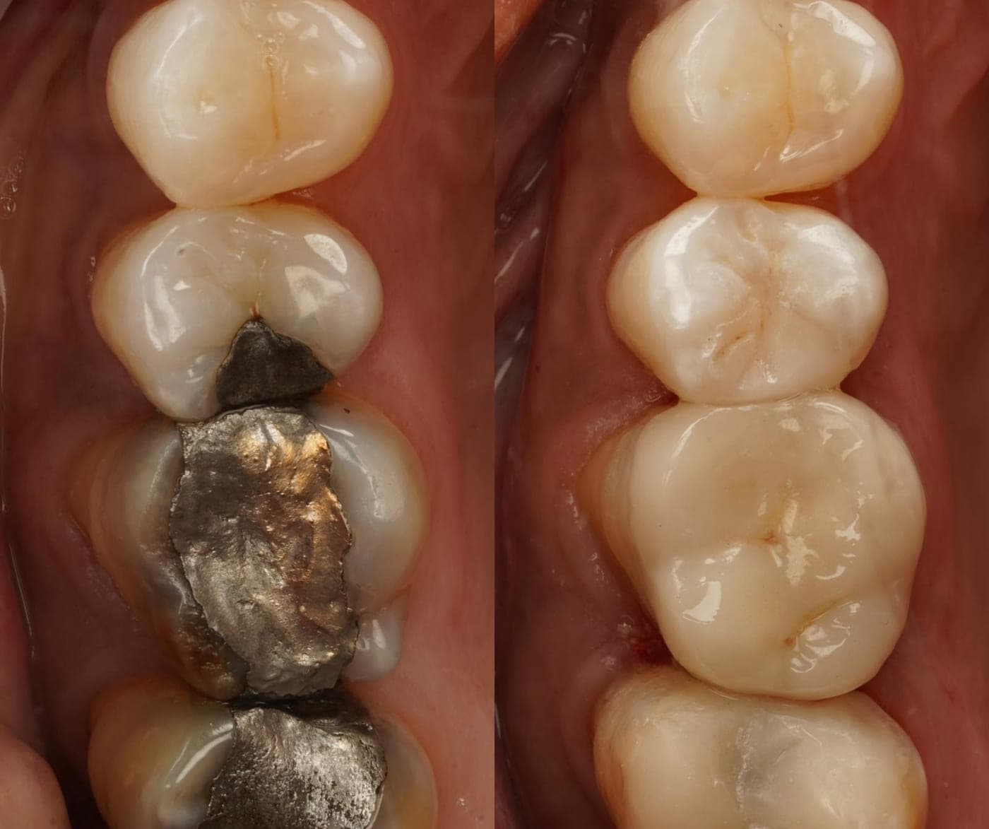 Side-by-side clinical photographs of the biting surfaces of two molars, before with large metal fillings and after with tooth-coloured restorations.