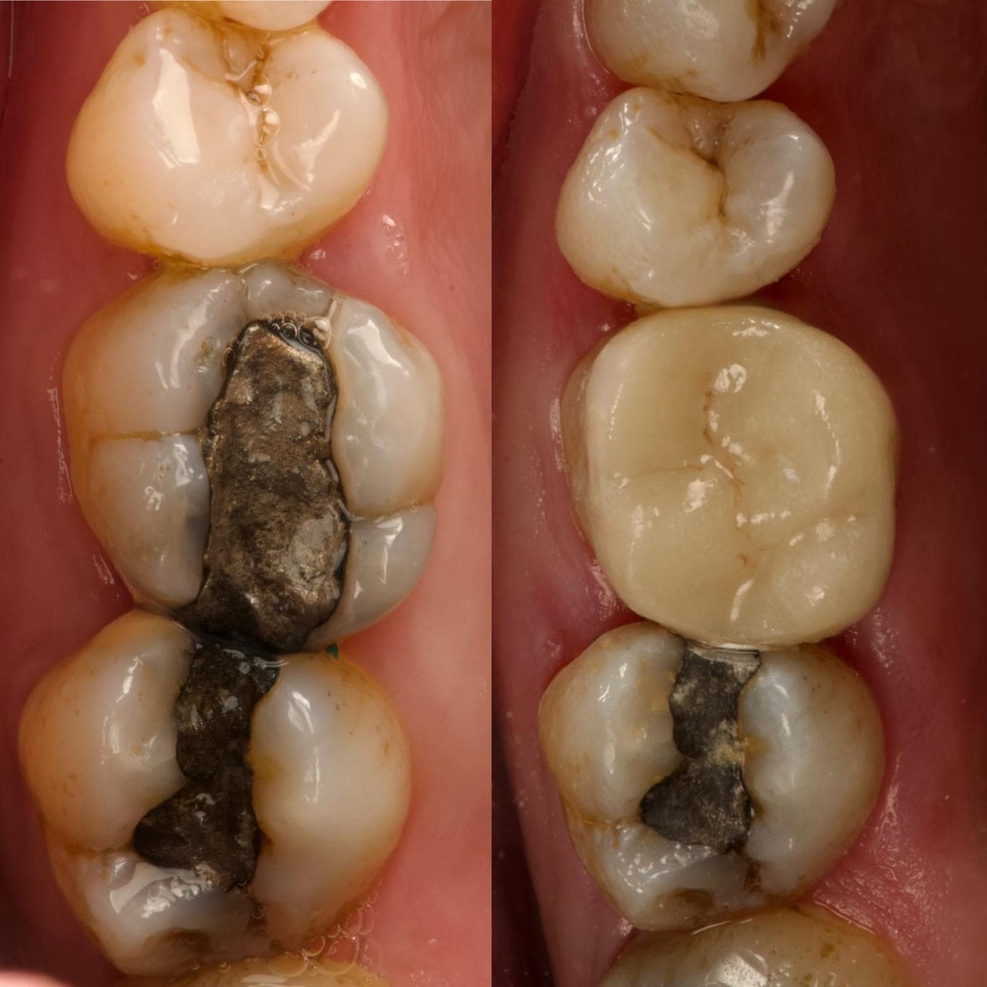 Side-by-side clinical photographs of a molar, before with a large metal filling and after with a ceramic onlay covering the biting surface.