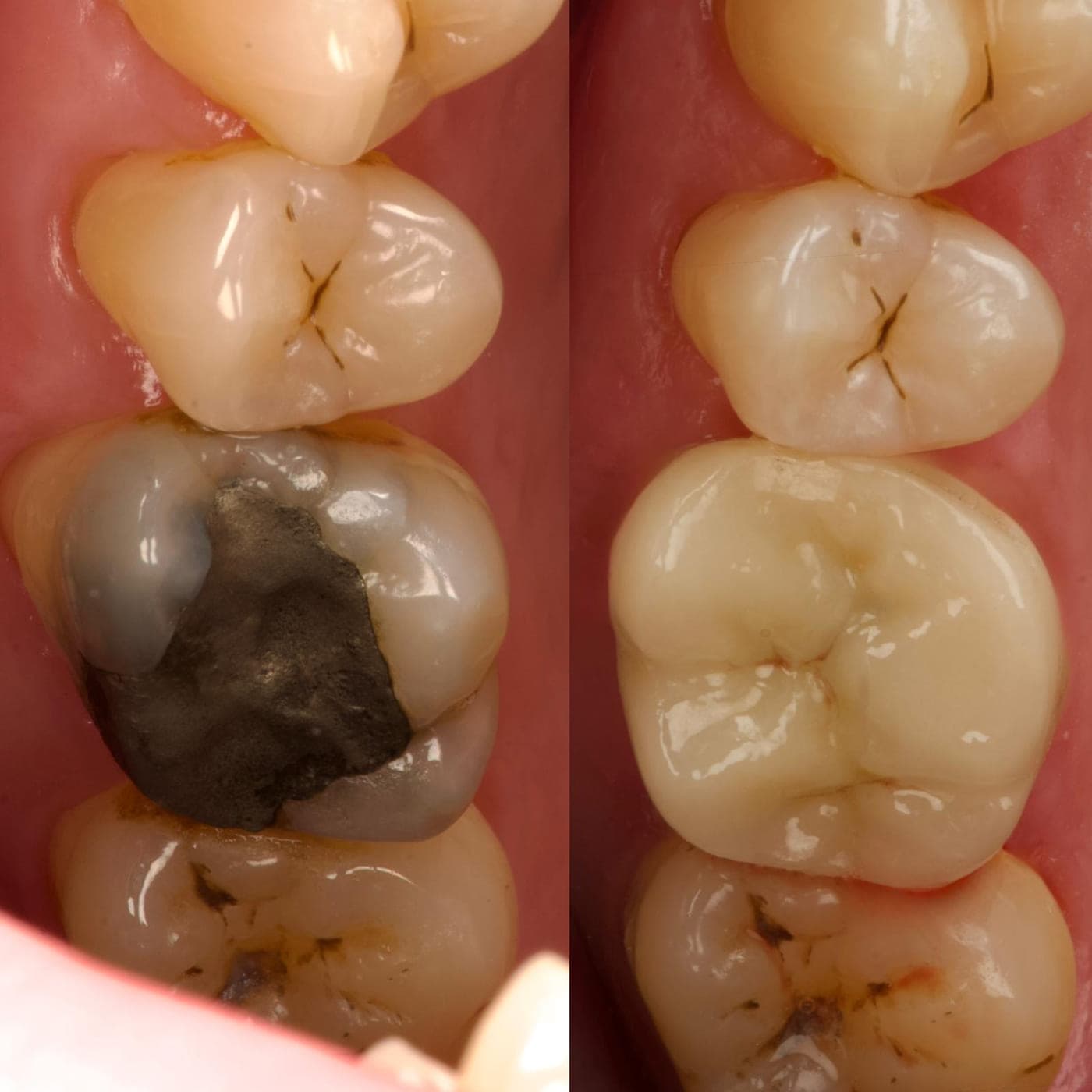Side-by-side clinical photographs of a molar, before with a large dark metal filling and after with a tooth-coloured restoration rebuilding the cusps.
