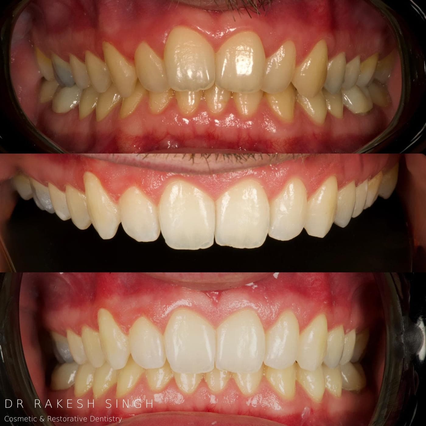 Three stacked clinical photographs showing the front teeth before treatment, the restored upper teeth under isolation, and the completed result with the teeth together.