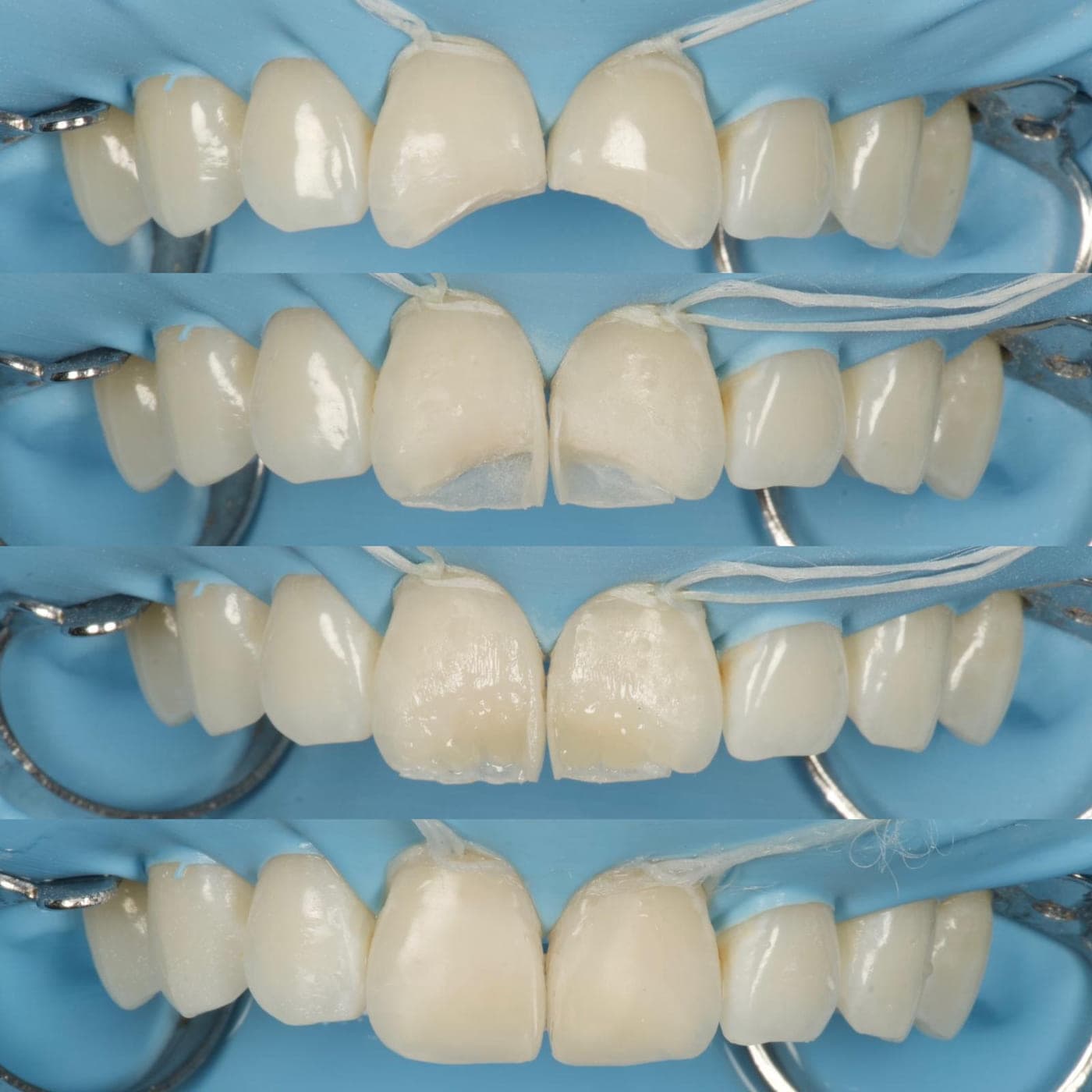 Four stacked clinical photographs showing composite being built up in layers on two upper central incisors isolated with a rubber dam.