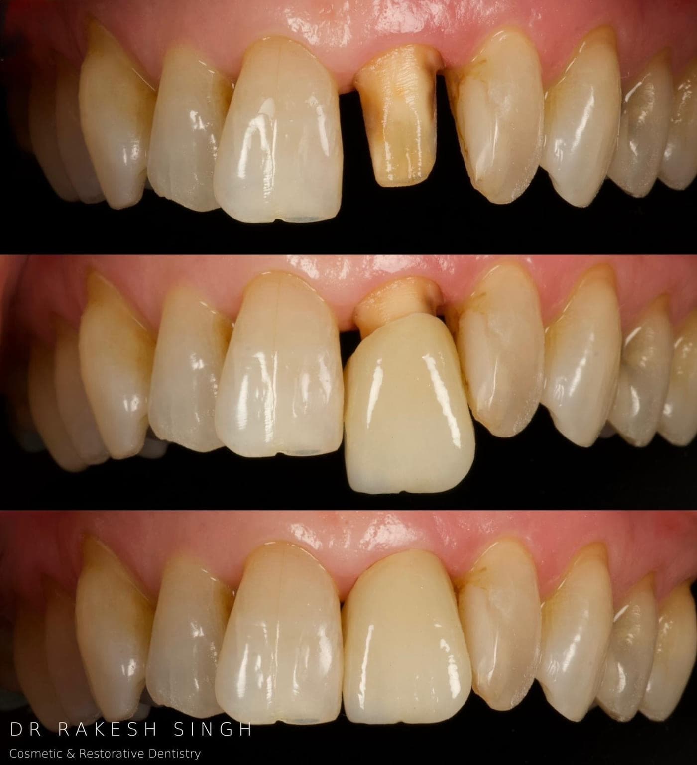Three stacked clinical photographs showing a discoloured prepared upper front tooth, the crown at try-in, and the finished crown in place alongside the natural teeth.