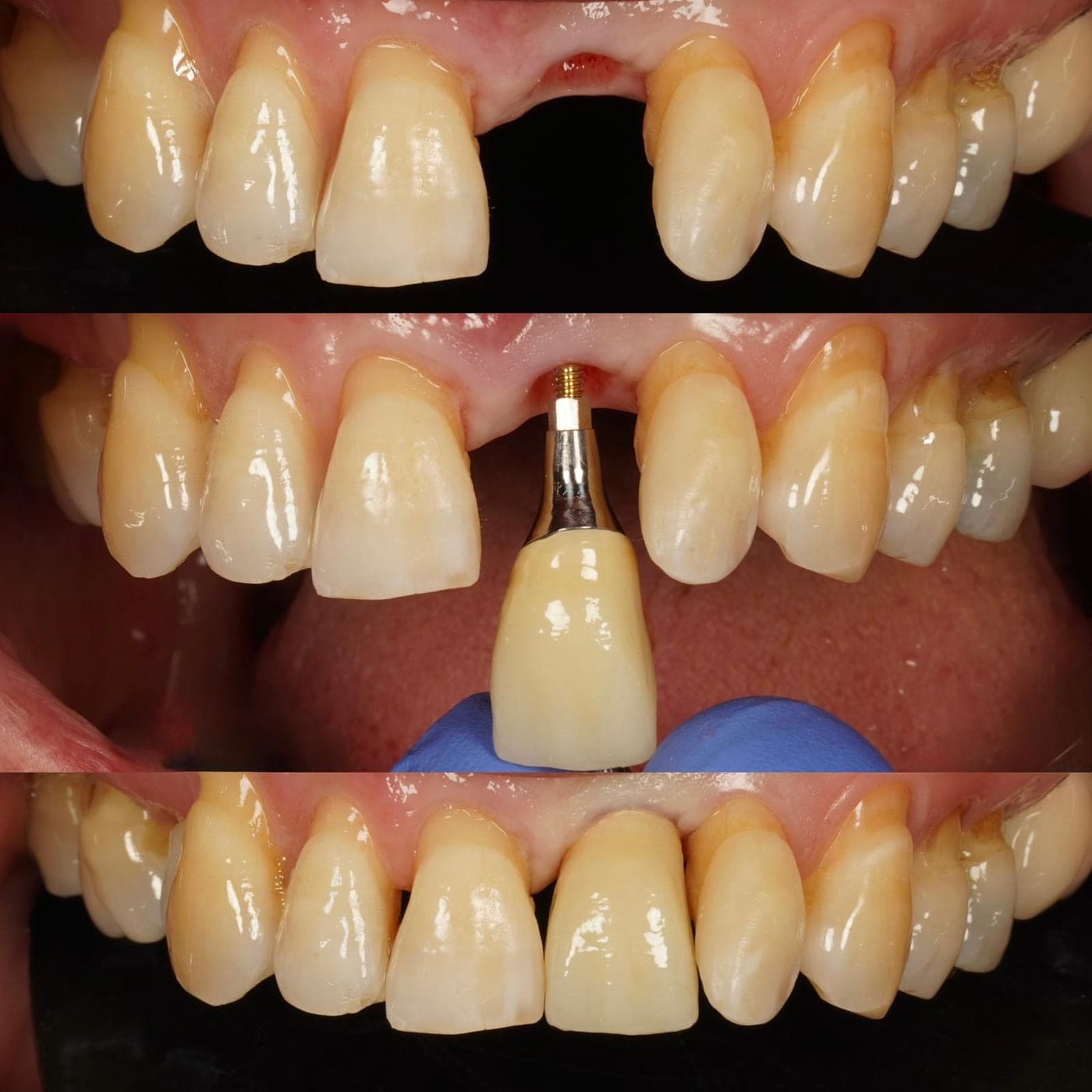 Three stacked clinical photographs showing a gap where an upper front tooth is missing, the implant crown and abutment before fitting, and the completed implant crown in place.