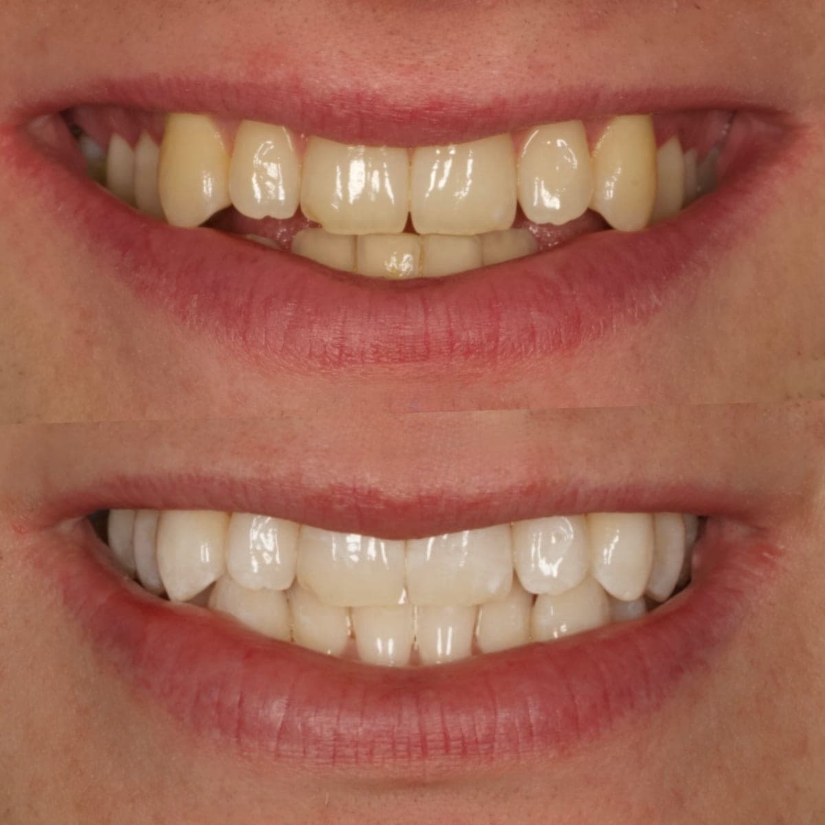 The same smile photographed before and after whitening. The upper photograph shows the natural, more yellow shade, the lower photograph the lighter, brighter shade after treatment.