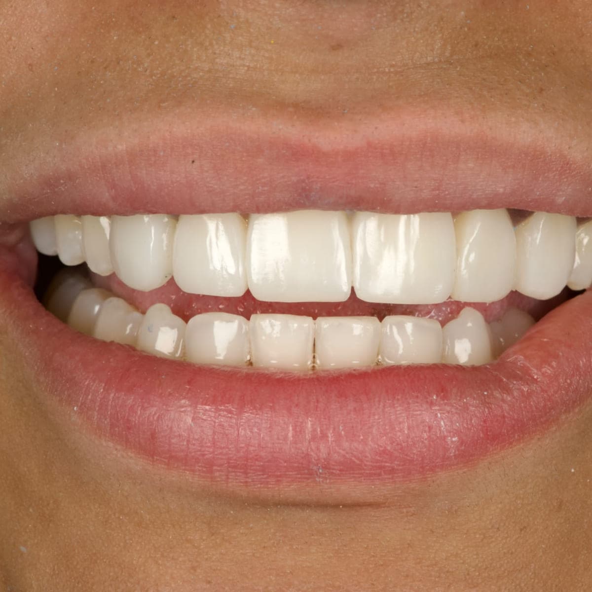 Close-up of a patient’s smile after composite bonding, showing the upper front teeth rebuilt to an even edge line and even proportions.