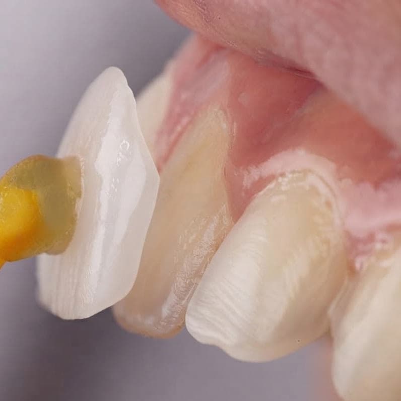 Close-up of a thin porcelain veneer held against a prepared upper front tooth before it is bonded into place.